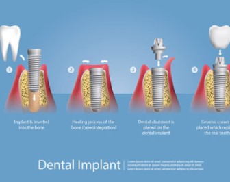 Top-Notch Things To Carry About Dental Implants Services Forever