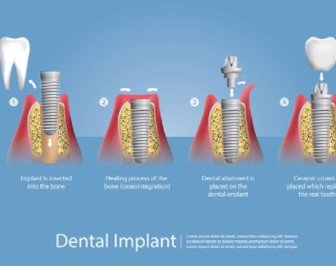 Dental Implants